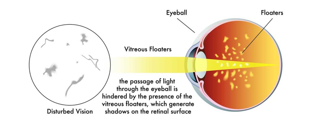 Eye Floaters - Symptoms and Causes - Eye Contact Optician